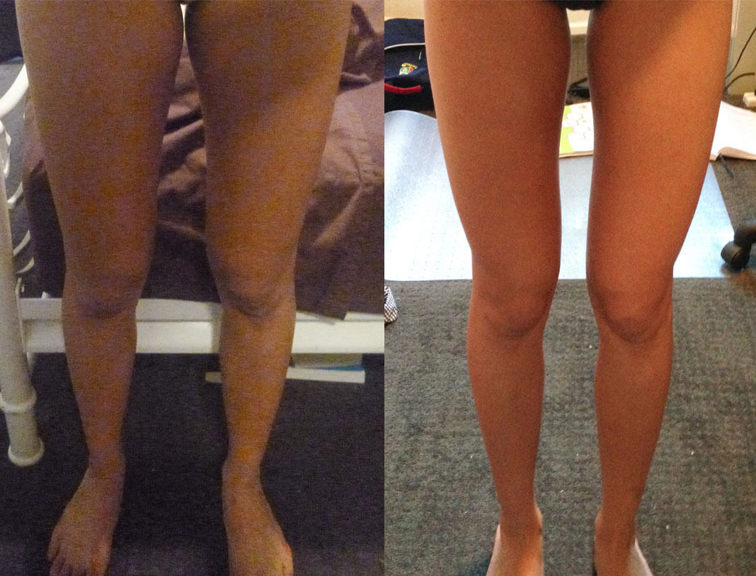 how to reduce fat from stubborn areas