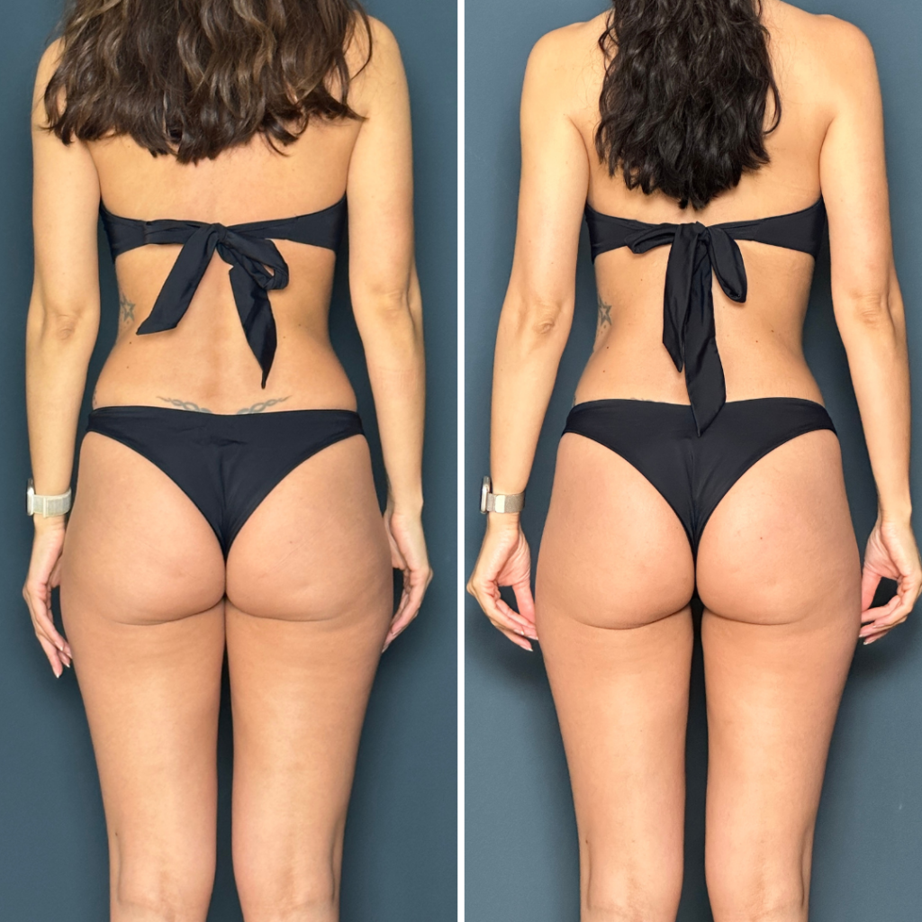 lean legs program before and after